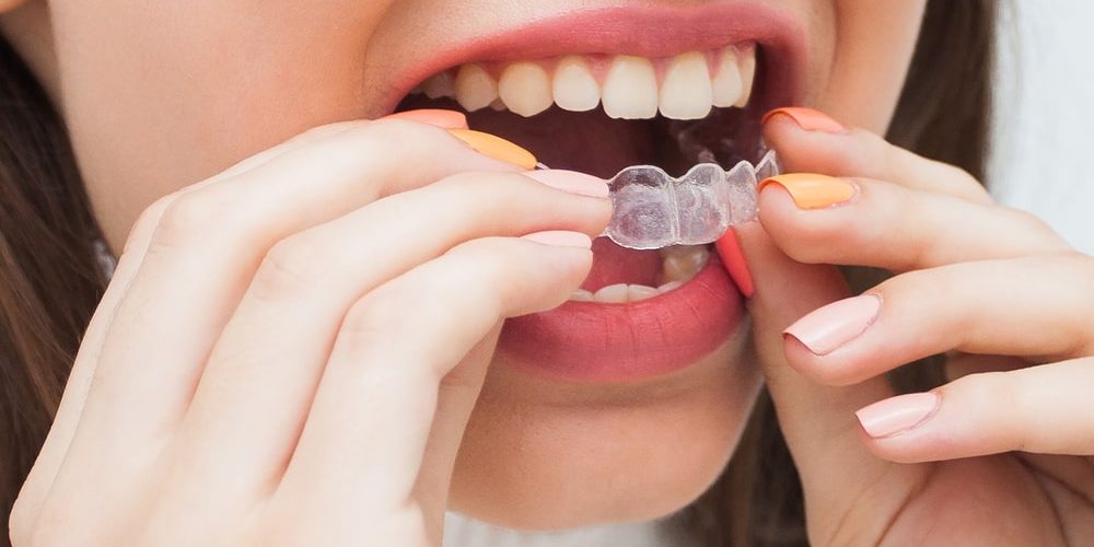 quali sono le caratteristiche e i dubbi più comuni sull'apparecchio trasparente per bambini e adolescenti Invisalign