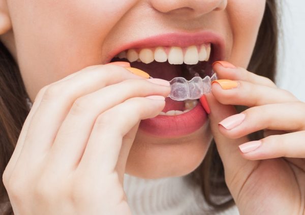 quali sono le caratteristiche e i dubbi più comuni sull'apparecchio trasparente per bambini e adolescenti Invisalign