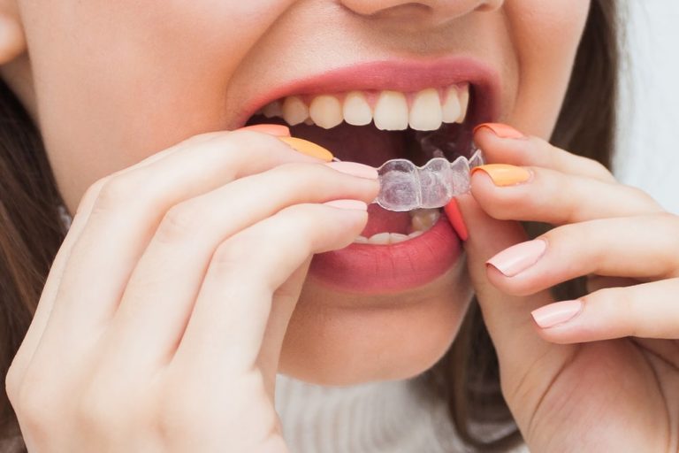 quali sono le caratteristiche e i dubbi più comuni sull'apparecchio trasparente per bambini e adolescenti Invisalign