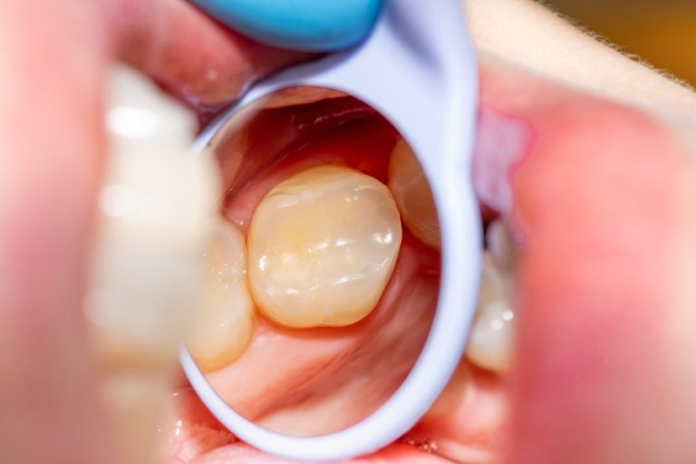 Ortodontista controlla i denti ad un bambino e trova una carie del colletto