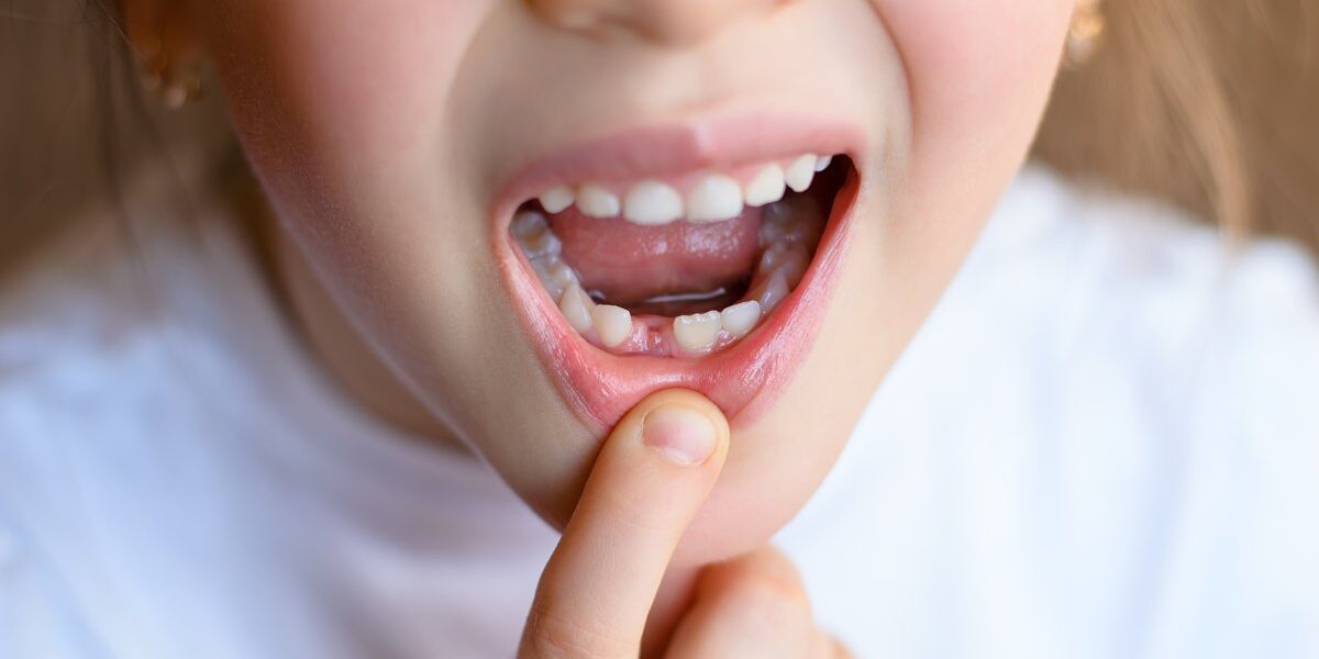 bambina mostra i denti da latte che non cadono prima di andare ad una visita dalla sua ortodontista