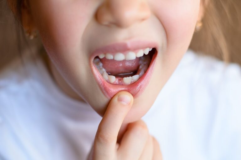 bambina mostra i denti da latte che non cadono prima di andare ad una visita dalla sua ortodontista